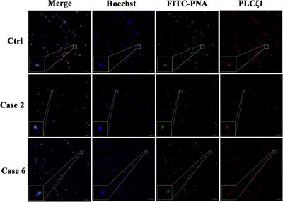 A Novel Assisted Oocyte Activation Method Improves Fertilization in Patients With Recurrent Fertilization Failure